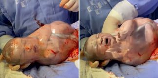 Em parto raríssimo, bebê nasce envolvido em bolsa amniótica – veja o vídeo