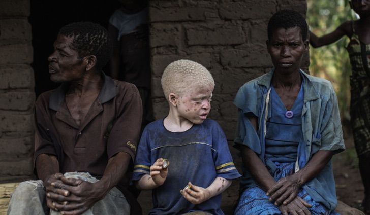 agrandeartedeserfeliz.com - “Estou viciado nela”: nigeriano pediu em casamento uma jovem albina que foi rejeitada pela família