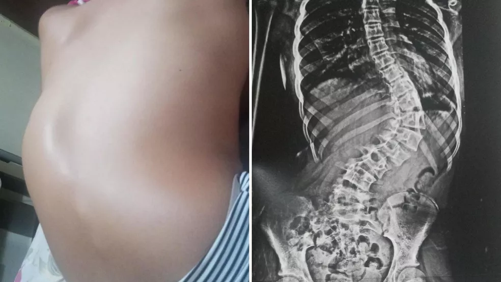 agrandeartedeserfeliz.com - Menina com 'coluna em S' anda ereta pela 1ª vez após cirurgia de correção da curvatura