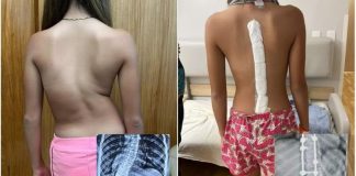 Menina com ‘coluna em S’ anda ereta pela 1ª vez após cirurgia de correção da curvatura