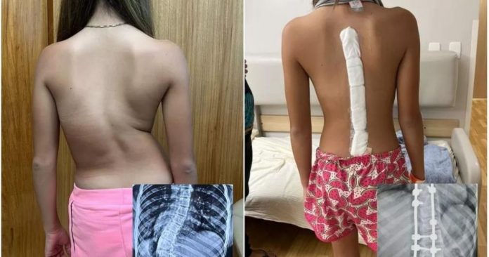 Menina com ‘coluna em S’ anda ereta pela 1ª vez após cirurgia de correção da curvatura
