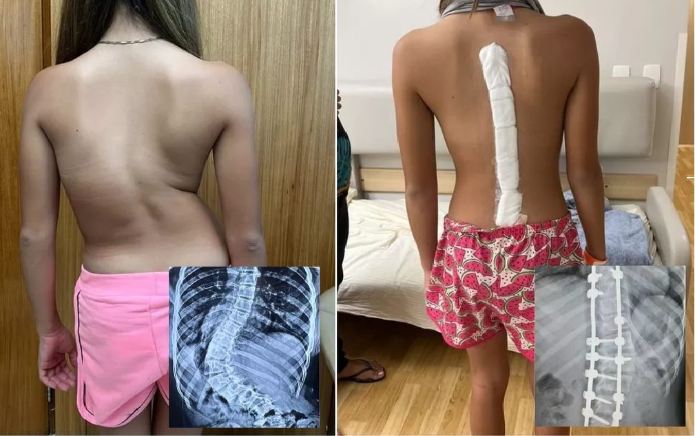 agrandeartedeserfeliz.com - Menina com 'coluna em S' anda ereta pela 1ª vez após cirurgia de correção da curvatura