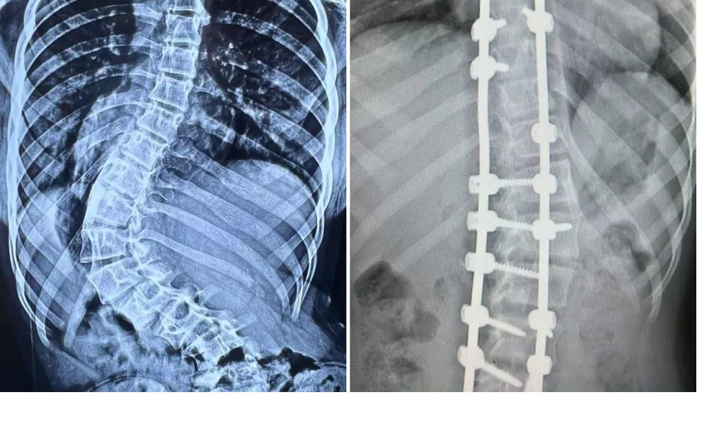 agrandeartedeserfeliz.com - Menina com 'coluna em S' anda ereta pela 1ª vez após cirurgia de correção da curvatura