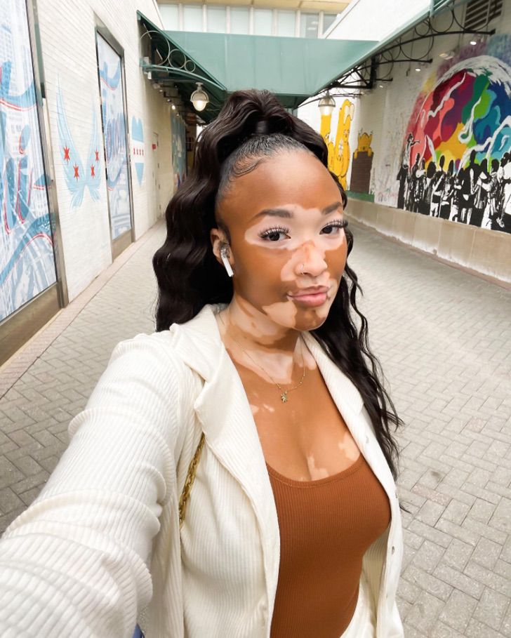 agrandeartedeserfeliz.com - Após anos se escondendo, jovem com vitiligo mostra sua pele única ao mundo e viraliza