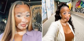 Após anos se escondendo, jovem com vitiligo mostra sua pele única ao mundo e viraliza