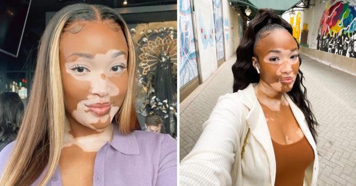 Após anos se escondendo, jovem com vitiligo mostra sua pele única ao mundo e viraliza