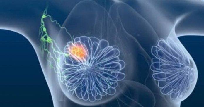 Tratamento inovador promete eliminar o câncer de mama ainda nos estágios iniciais