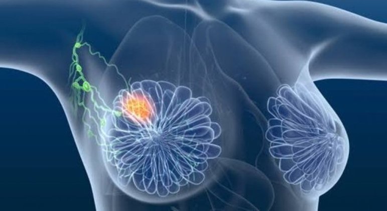 agrandeartedeserfeliz.com - Tratamento inovador promete eliminar o câncer de mama ainda nos estágios iniciais