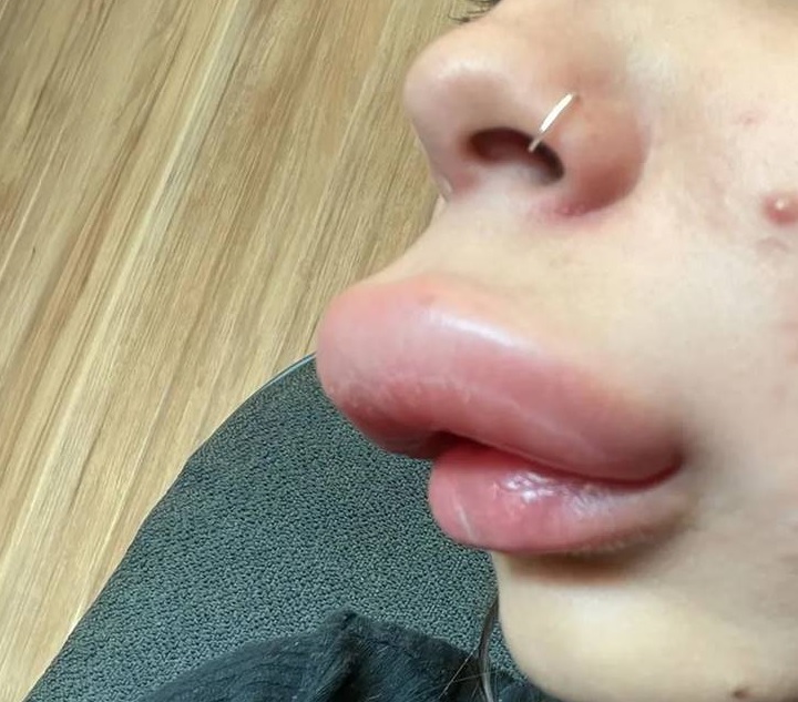 agrandeartedeserfeliz.com - Estudante tem reação alérgica bizarra ao reverter preenchimento labial; veja fotos