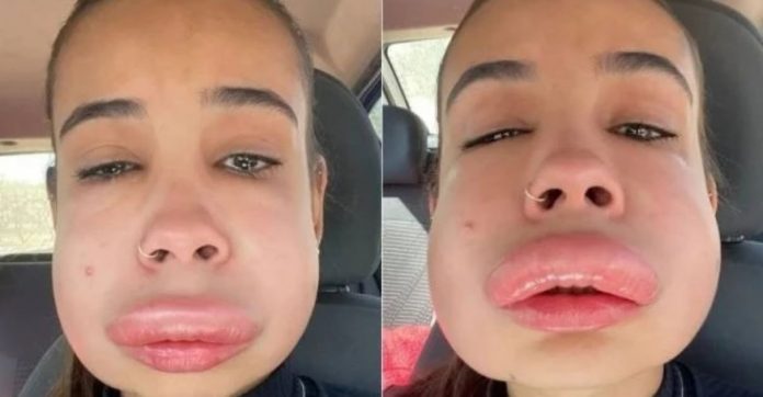 Estudante tem reação alérgica bizarra ao reverter preenchimento labial; veja fotos