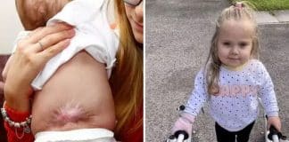 Bebê consegue andar graças a cirurgia feita ainda no útero da mãe