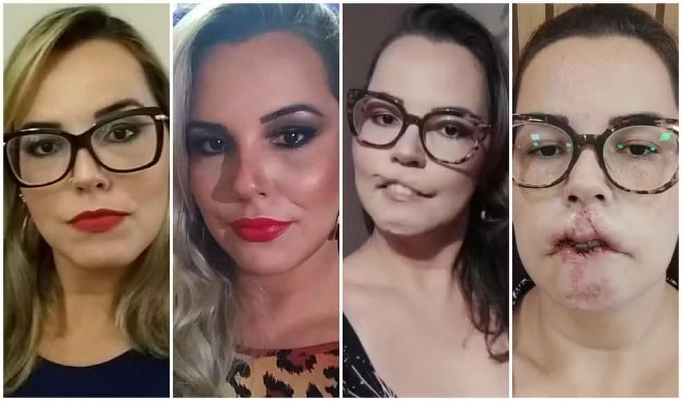 agrandeartedeserfeliz.com - Mulher perde lábios após harmonização "fake" - dentista enxertou plástico nela