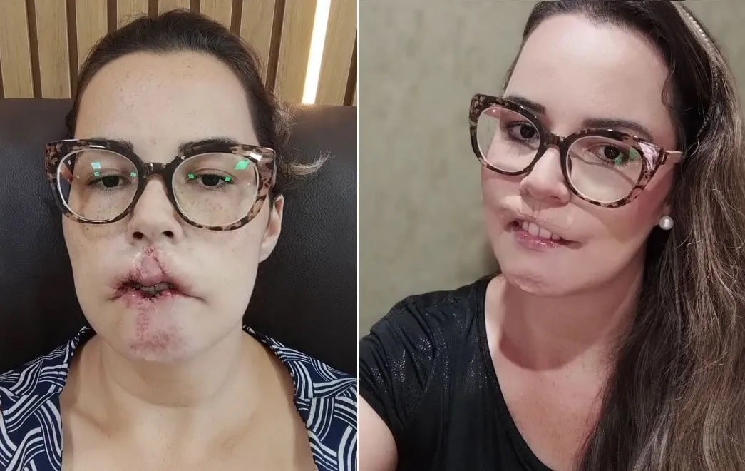 agrandeartedeserfeliz.com - Mulher perde lábios após harmonização "fake" - dentista enxertou plástico nela
