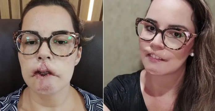 Mulher perde lábios após harmonização “fake” – dentista enxertou plástico nela